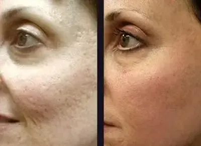 Ennen ja jälkeen Microneedling, tasaisempi ihonsävy
