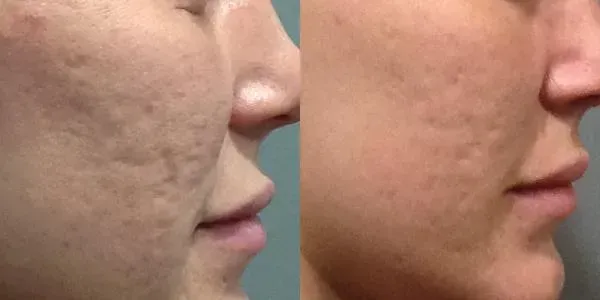 Ennen ja jälkeen Microneedling, tasoittuneet aknearpet