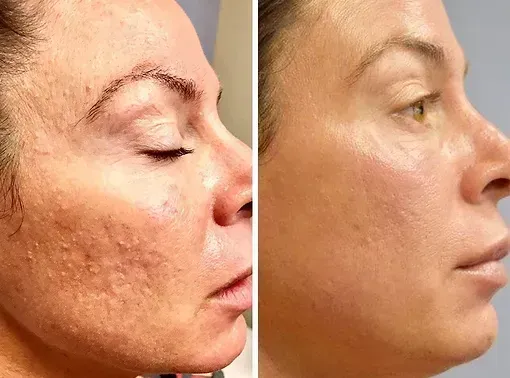 Ennen ja jälkeen Microneedling, pienemmät arvet