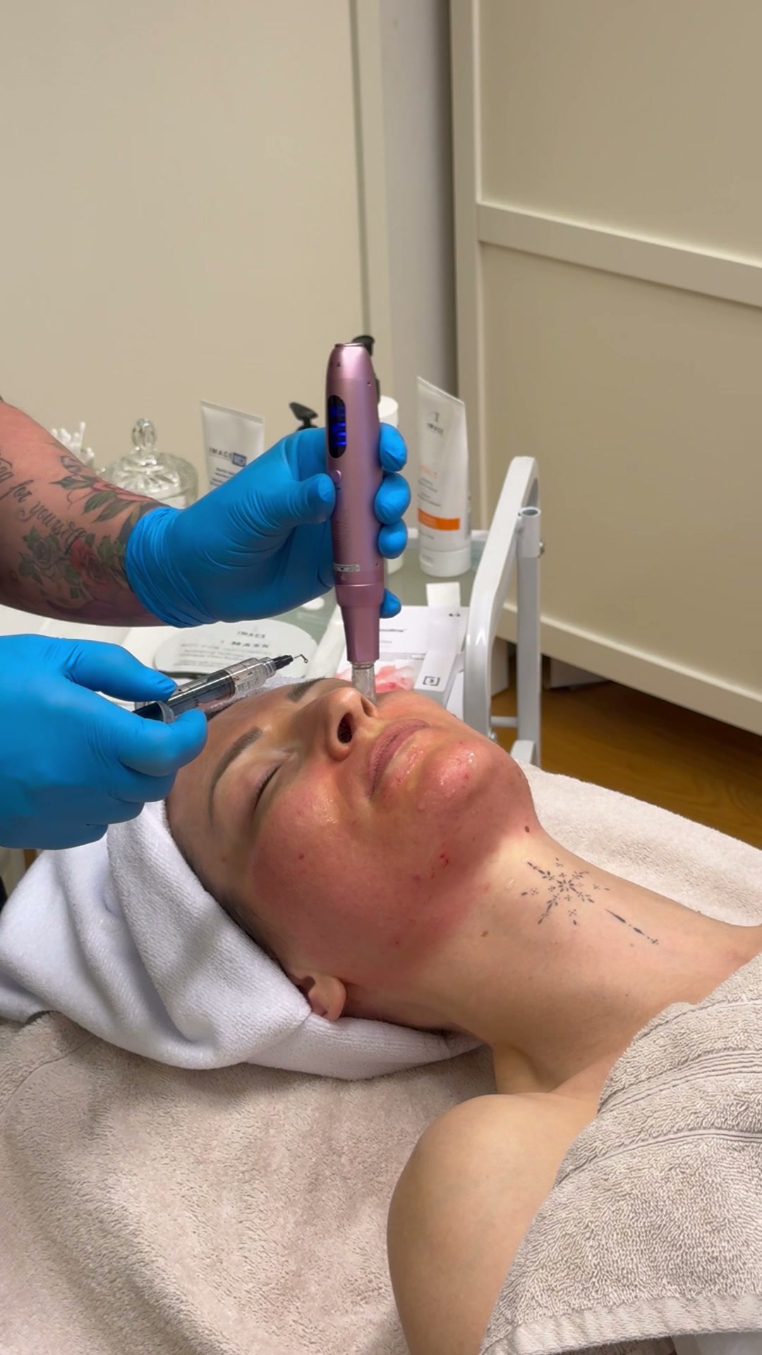 Microneedling-hoito Wasa Aestheticsilla Vaasassa